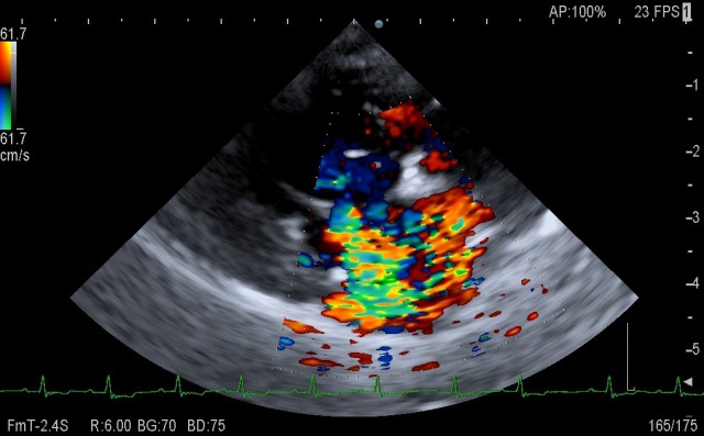 犬の僧帽弁閉鎖不全症の心臓エコー