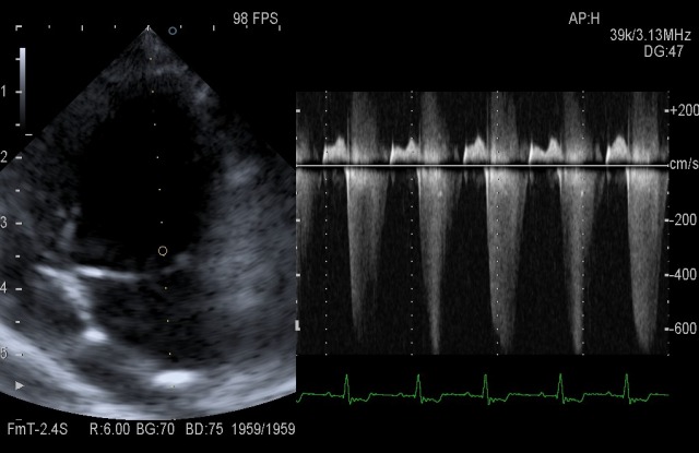 犬の僧帽弁閉鎖不全症の心臓エコー