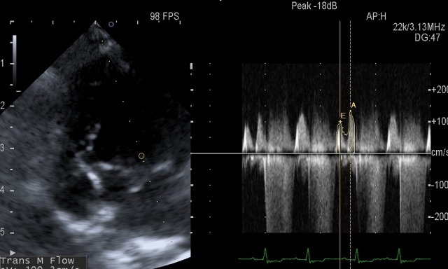 犬の僧帽弁閉鎖不全症の心臓エコー