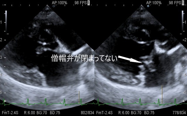 犬の僧帽弁閉鎖不全症の心臓エコー