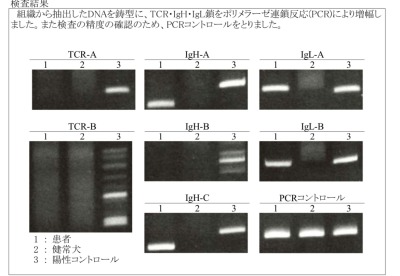 リンパ球クローナリティ検査